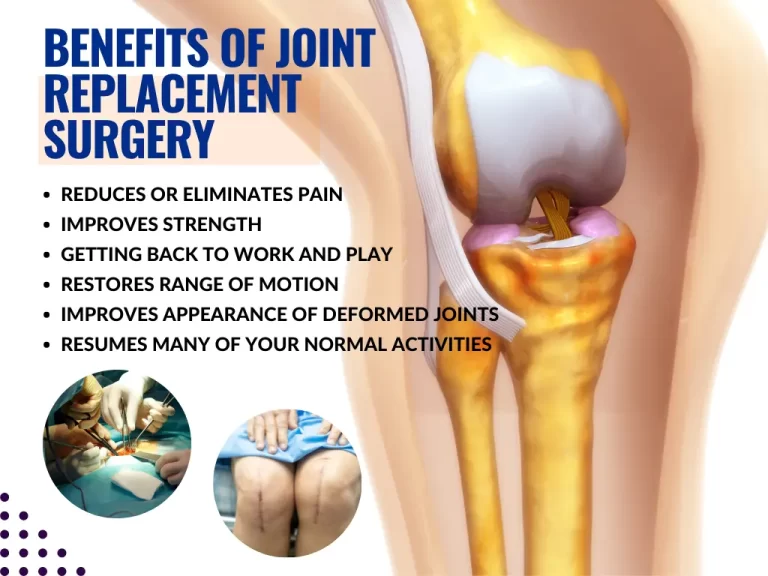 Joint Replacement Surgery