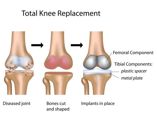 Knee Replacement Surgery